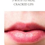 cracked lips